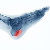 Heel Spurs
