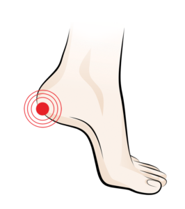 Plantar Fasciitis