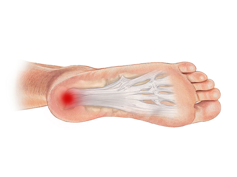 Plantar Fasciitis Heel Pain