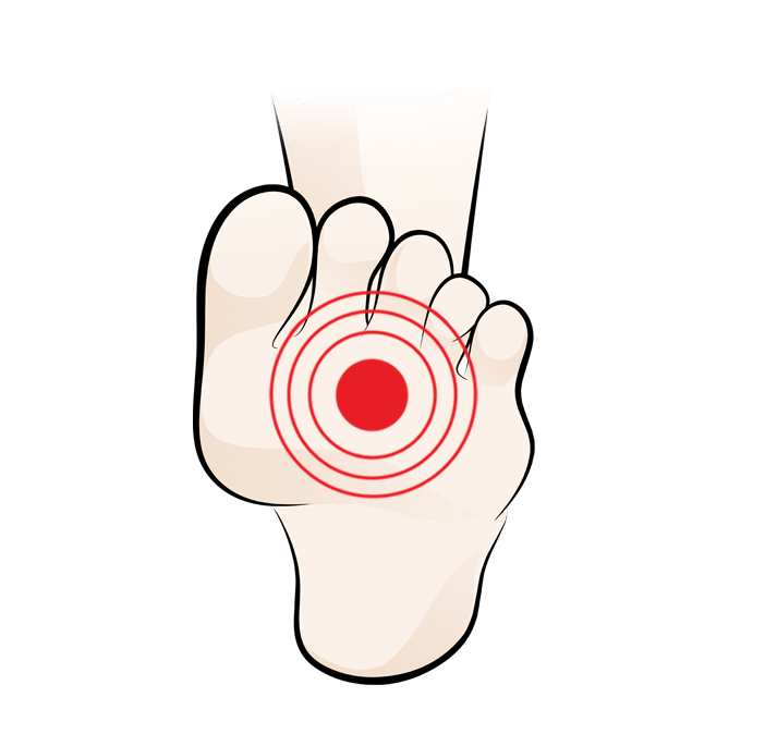 Illustration of a foot with a red target symbol on the ball, indicating pain or discomfort in that area.