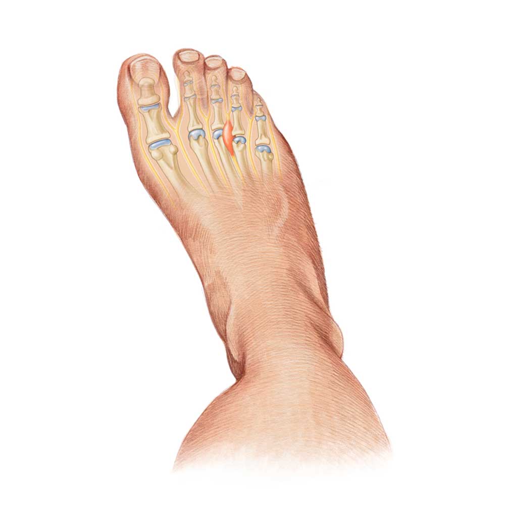 Anatomical illustration of a human foot showing bones, joints, and nerves in the toes and upper foot, viewed from above.