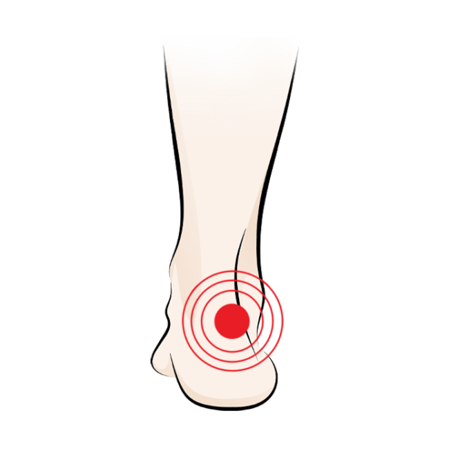 Illustration of a foot with a red target marking pain or discomfort on the outer side of the ankle.