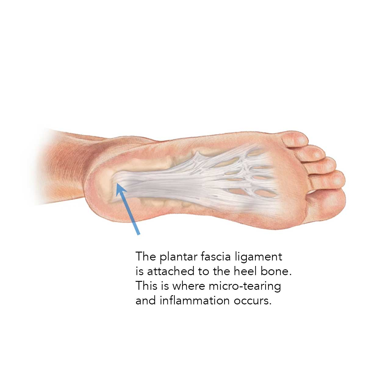 heel pain - plantar fascia