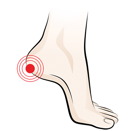Plantar Fasciitis pain in the heel
