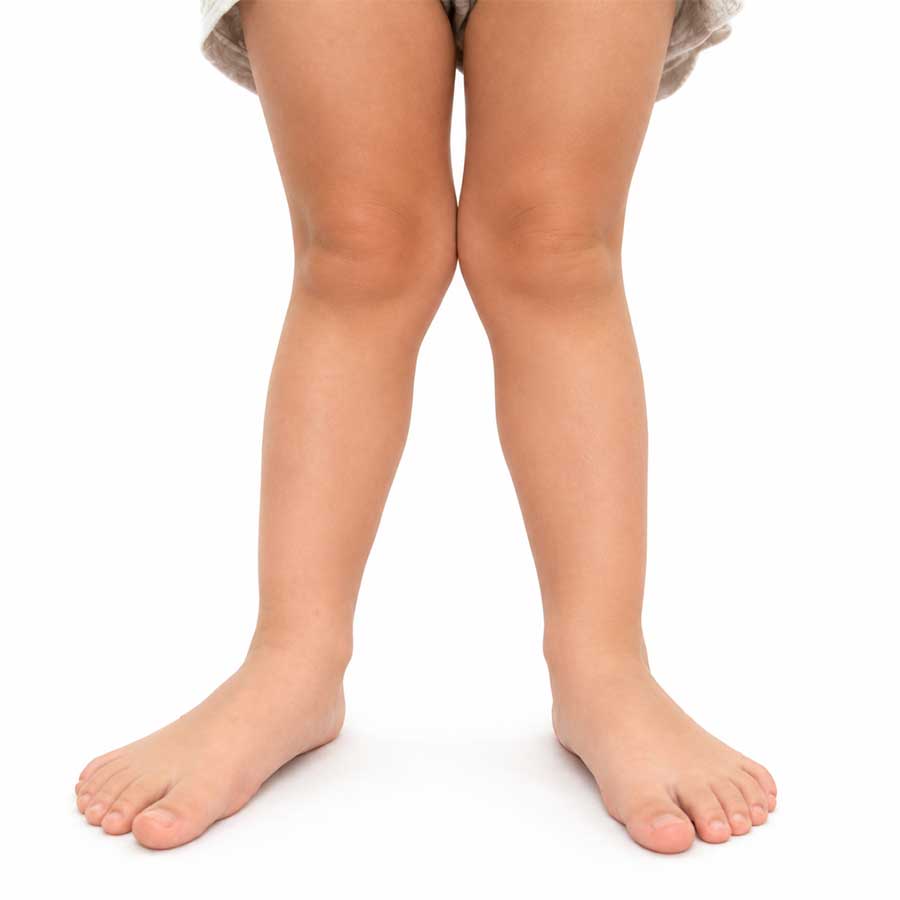 Child with knock knees